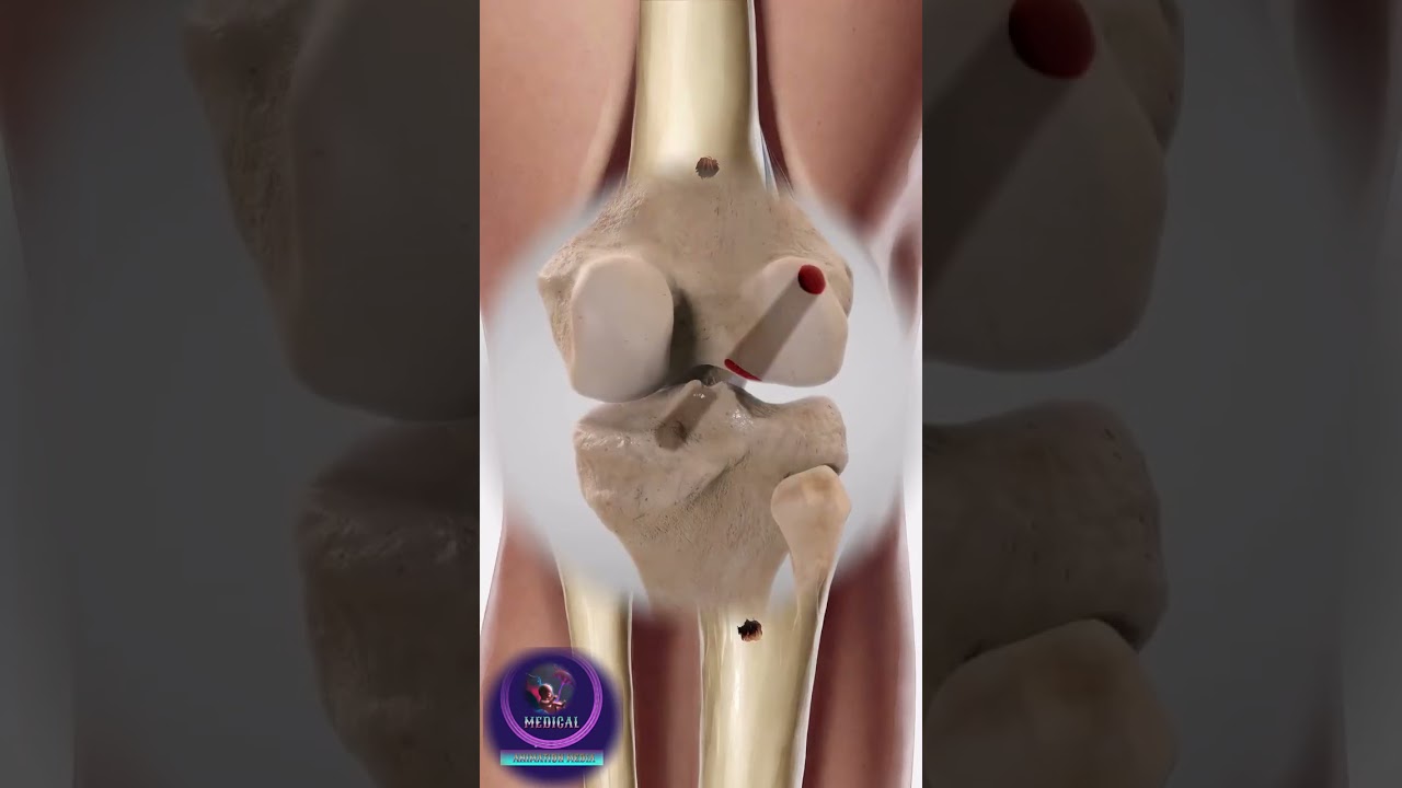 🛠️ Полное восстановление: изнутри процесса реконструкции передней крестообразной связки