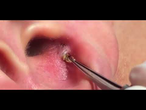 One blackhead with 5/6 holes!!! - YouTube One blackhead with 5/6 holes!!! - YouTube