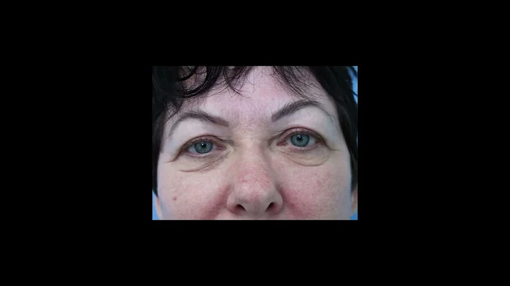 Dr. Joseph J Castellano | Before & After Video: Ey...