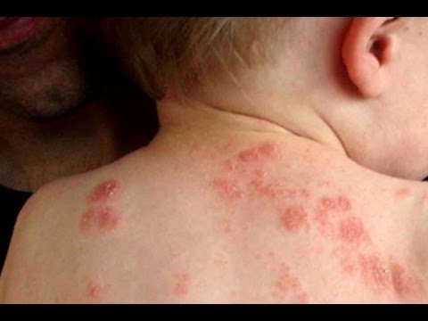 Bệnh chốc lở ở trẻ em || impetigo in kids