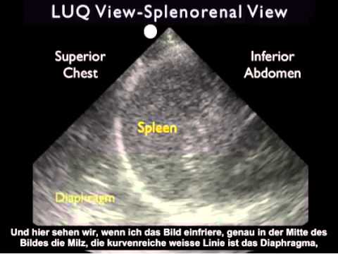 Anleitung: FAST-Traumauntersuchung – Untersuchung des linken Oberbauchs