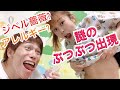 【採血😂💉】おなかに大量のぶつぶつが出てきたので調べてみた( TДT)〜ジベルばら色粃糠疹？アレルギー？の巻〜
