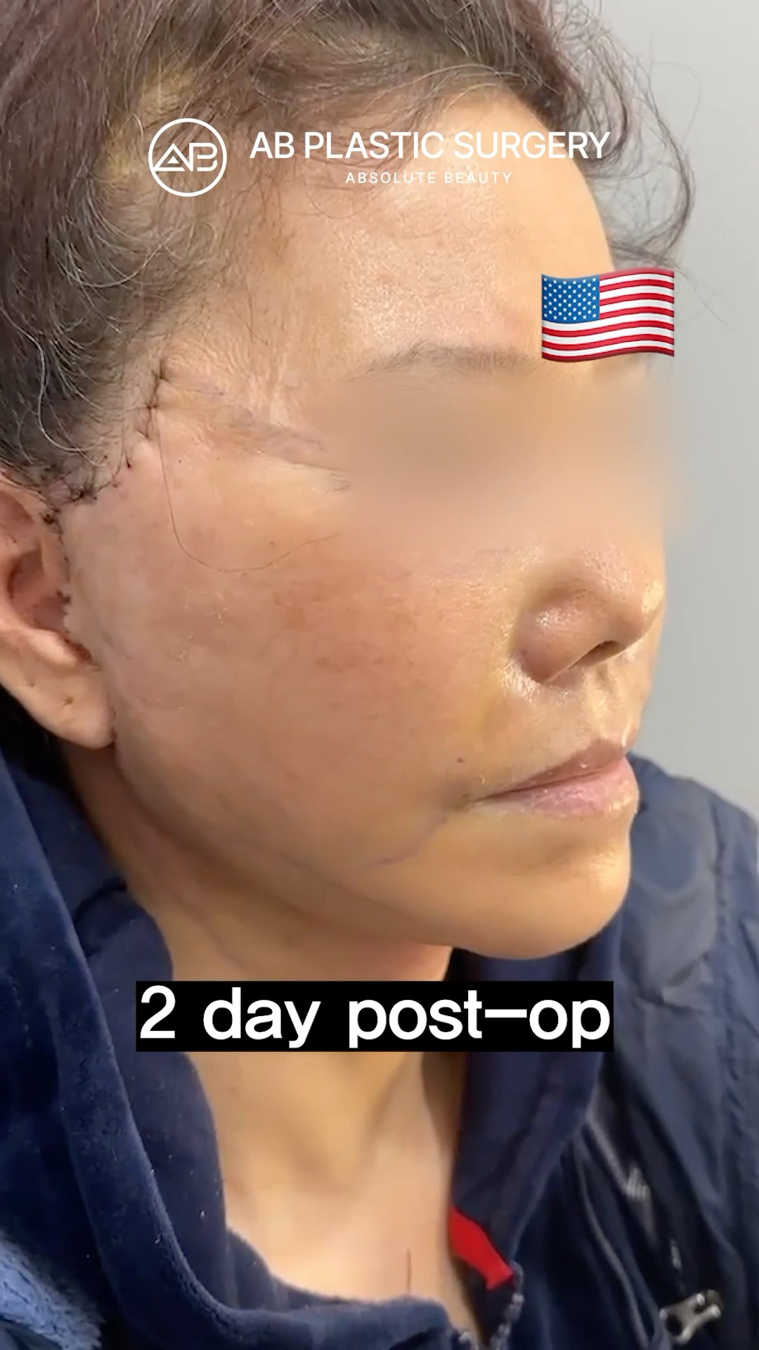 Day 2 After My Facelift #koreanplasticsurgery