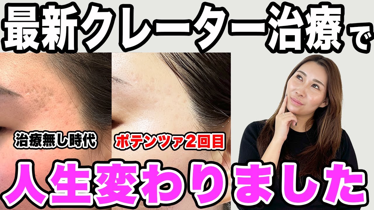 【最新クレーター治療レポ】酷く悩んでいたニキビ跡の効果的な治療を見つけたました。【ポテンツァ・サブシジョン】