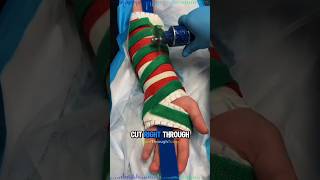 How Doctors Remove Casts Without Cutting You 🩺🤯