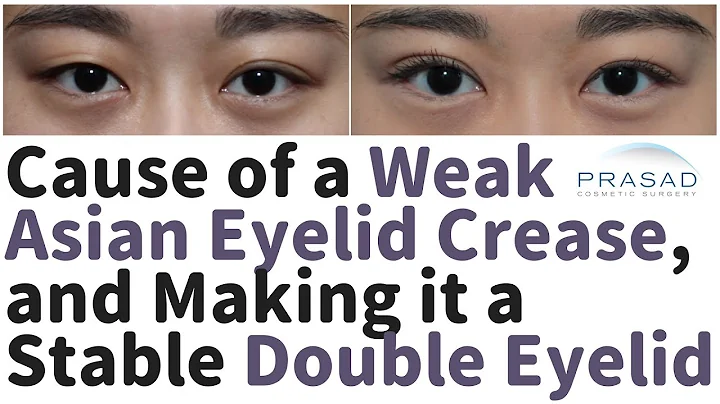 Cause of an Asian Double Eyelid  Becoming a Monolid or Multiple Creases, and How to Stabilize it - DayDayNews