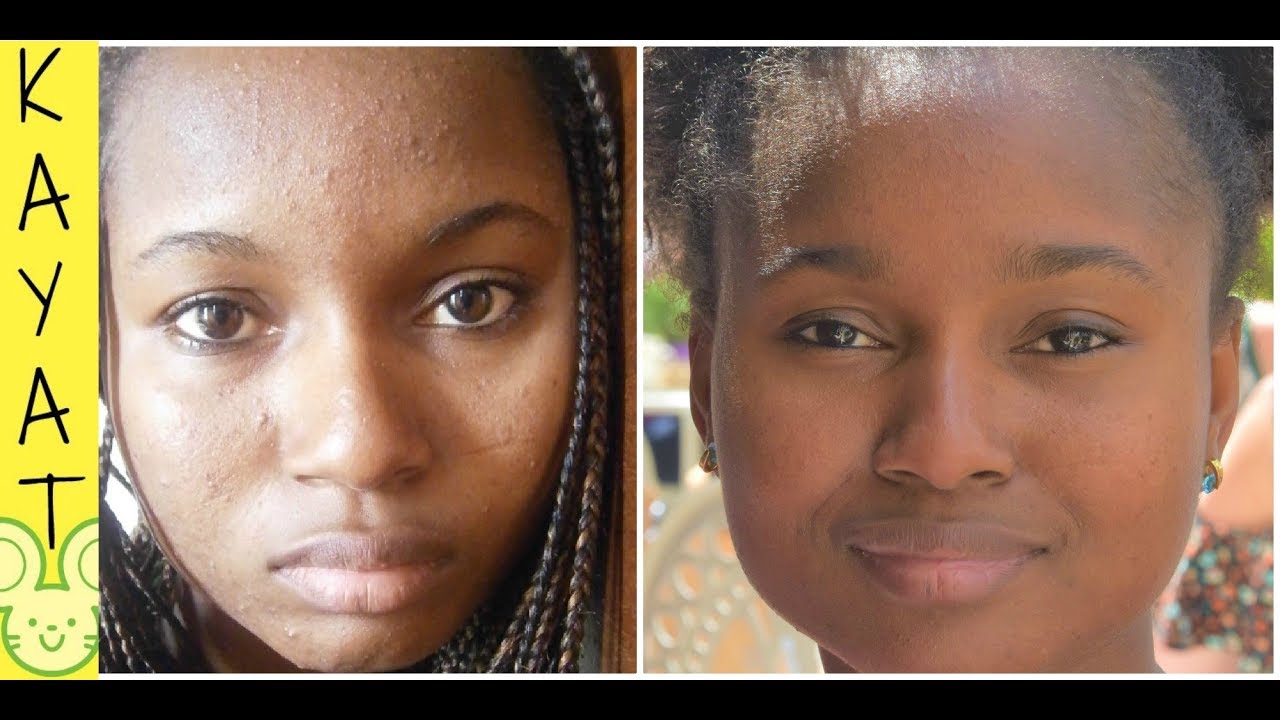 5 Astuces Pour Ne Plus Avoir De Boutons Partie 2 Kayatoo Youtube