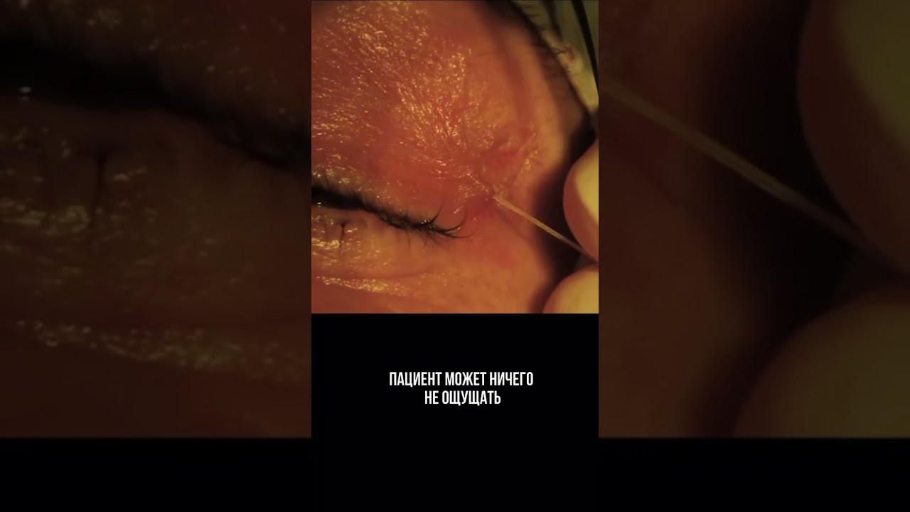 Дирофиляриоз обусловлен инфекцией паразитическими червями, известными как дирофилярии.