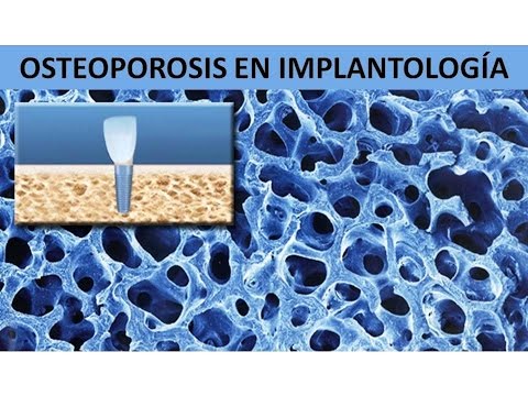 "OSTEOPOROSIS EN IMPLANTOLOGÍA ORAL" por la Dra. Carla Quintana