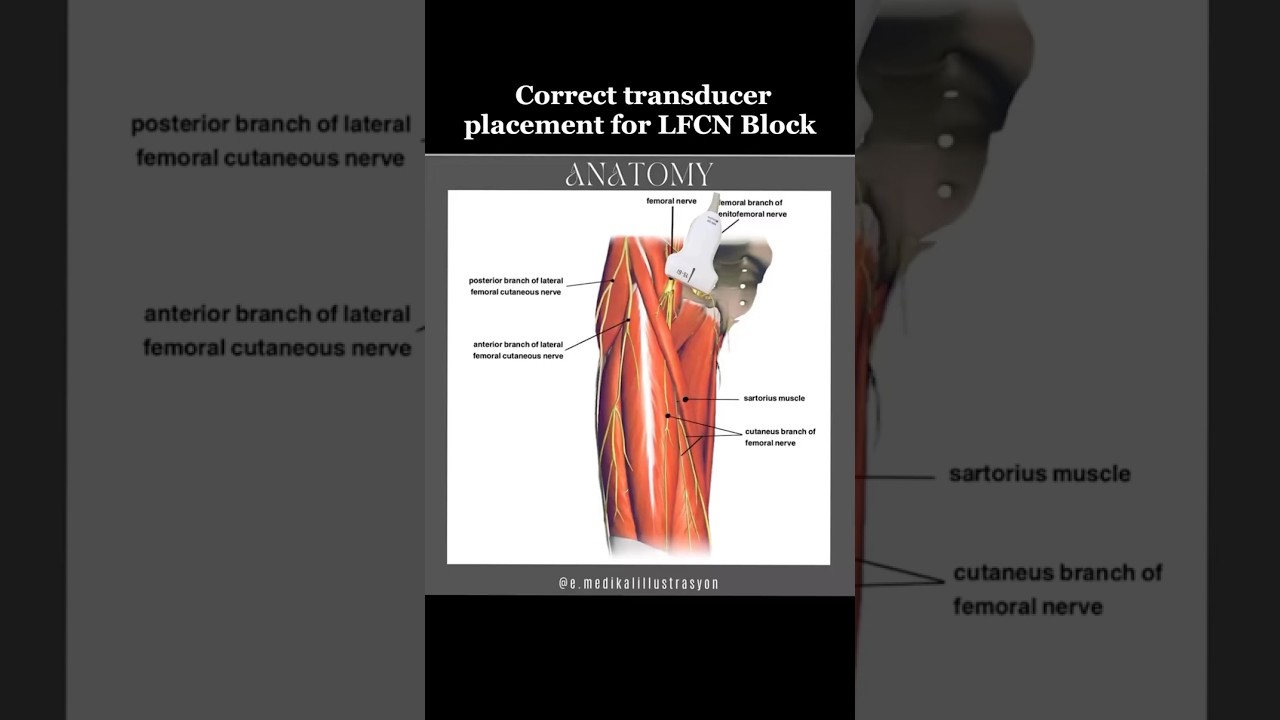 LFCN Block for Total Hip Surgery! 