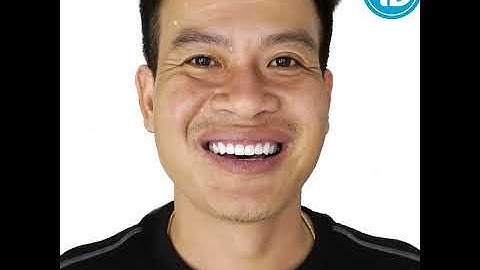 Bọc Răng Sứ An Toàn Không? Nha Khoa Thành Đạt - Nha Khoa Uy Tín Tại Biên Hòa