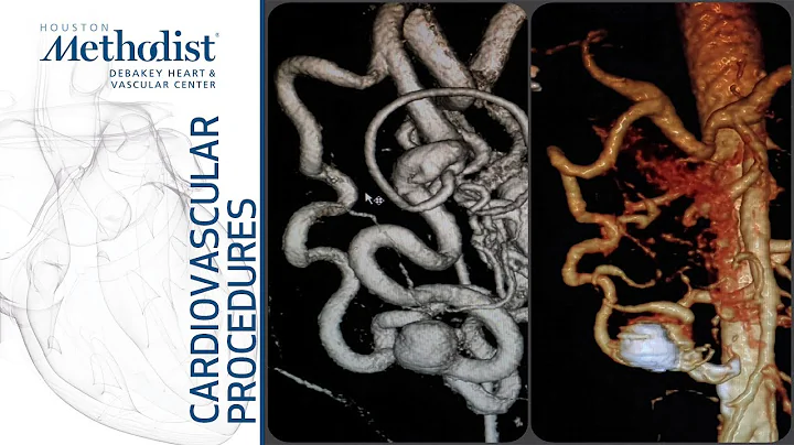 Embolization of Pancreaticoduode...  Artery Aneury...