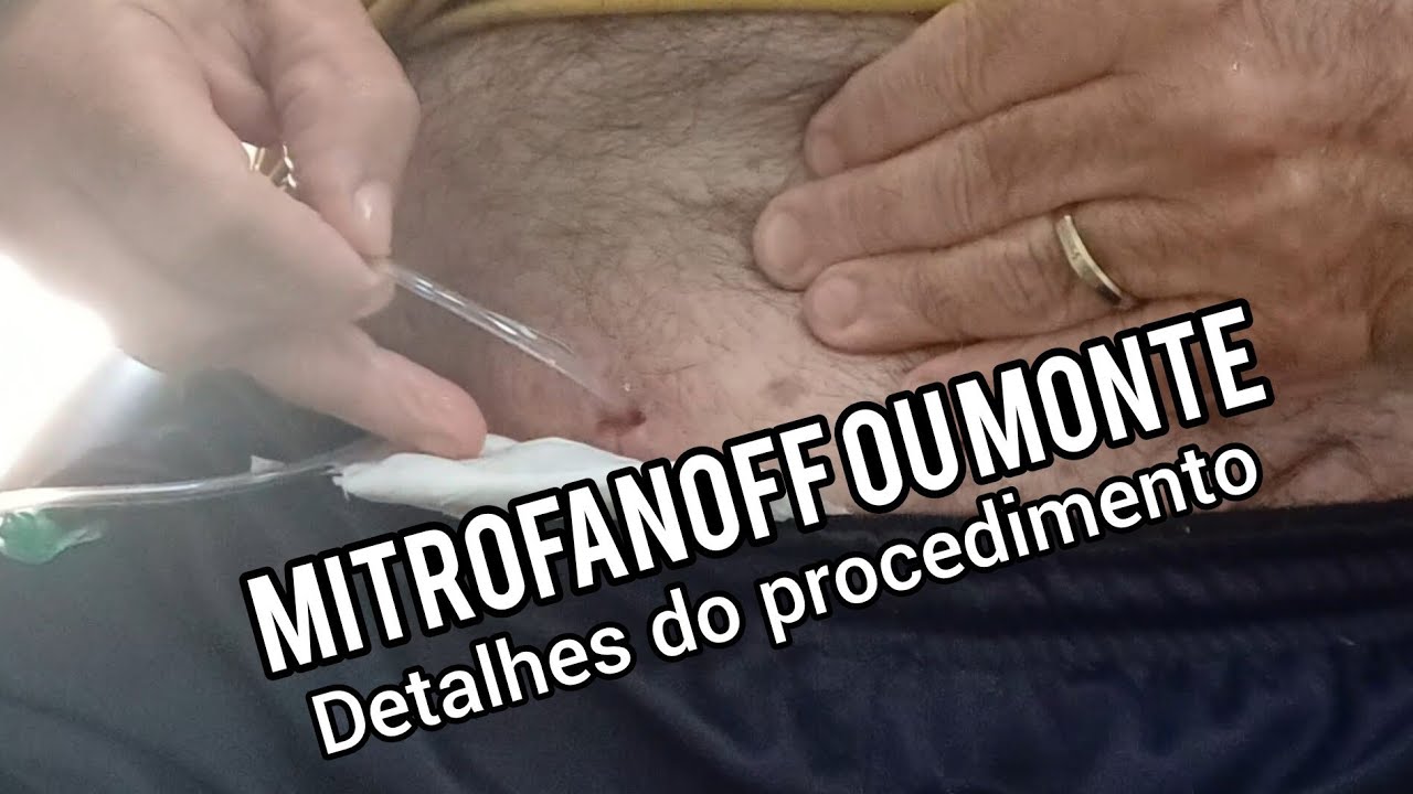 MITROFANOFF ou MONTE, DETALHES SOBRE O PROCEDIMENTO ...