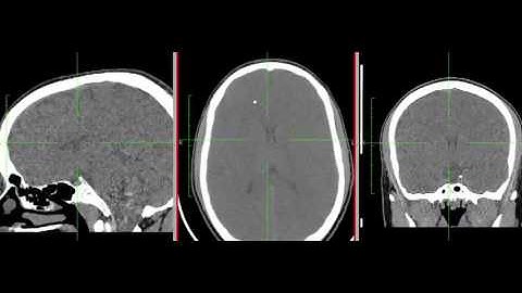 Computed Tomography Brain Imaging 5 - William Edward Hahn