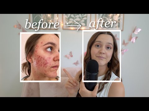 How to Actually Clear Your Acne (step-by-step cycle synch guide)