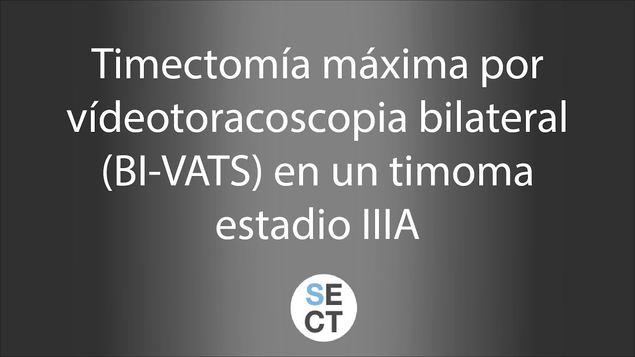 Timectomia Timectomía máxima por vídeotoracoscopia bilateral (BI-VATS) en un ...