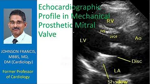 Echocardiographic Profile in Mechanical Prosthetic Mitral Valve