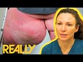 &quot;I&#39;d Like To Get A Knife And Cut It Off!&quot; GIANT Bump Dangles From Patients Leg | The Bad Skin Clinic