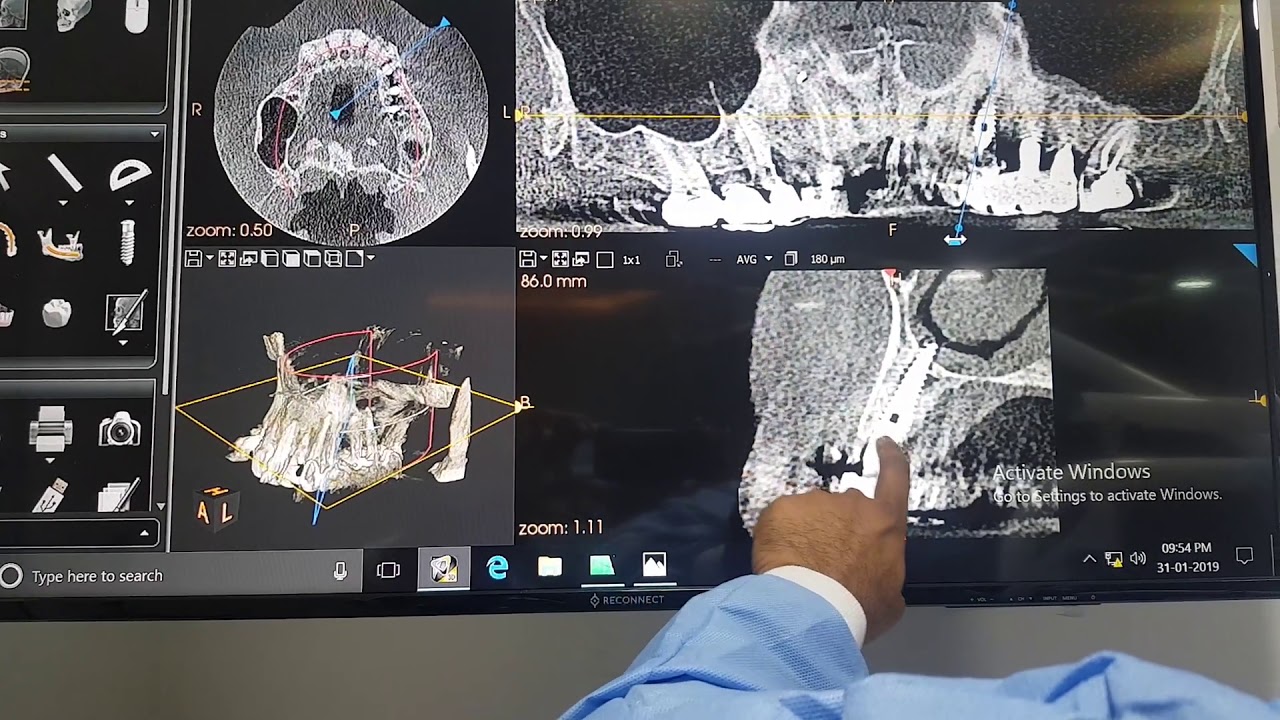 TILTED IMPLANTS DO WORK WITH TTPHIL ALL TILT PROTOCOL - YouTube