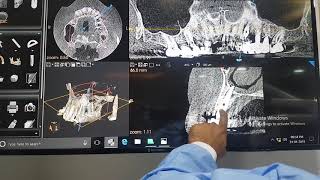 TILTED IMPLANTS DO WORK WITH TTPHIL ALL TILT PROTOCOL