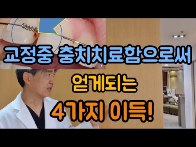 교정중 충치치료함으로써 얻게되는 4가지이득!