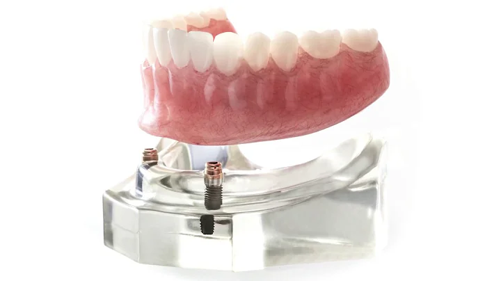 FAQ: Can you help my dentures fit better? | Brookfield Dentist | Elmbrook Family Dental