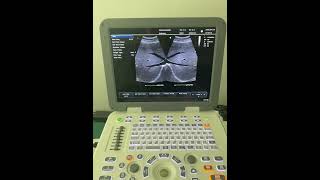 N36 N38 Portable Ultrasound Liver B-Mode Imaging Clear Detailed Visualization