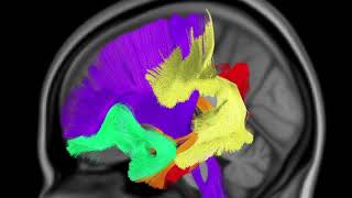 Major white matter pathways of the brain