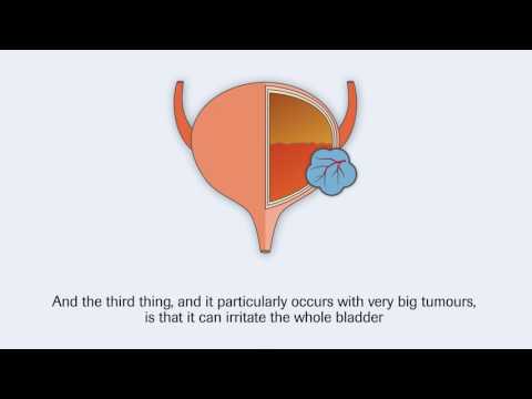 Bladder cancer and its signs and symptoms