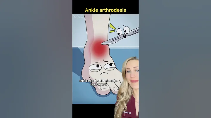 Doctor explains: ankle fusion surgery
