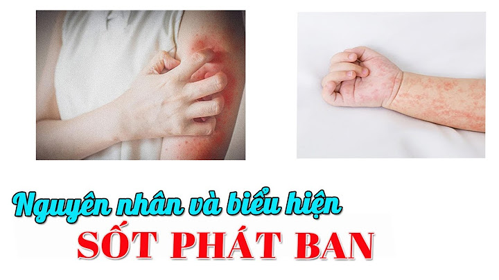 Sốt phát ban nguyên nhân