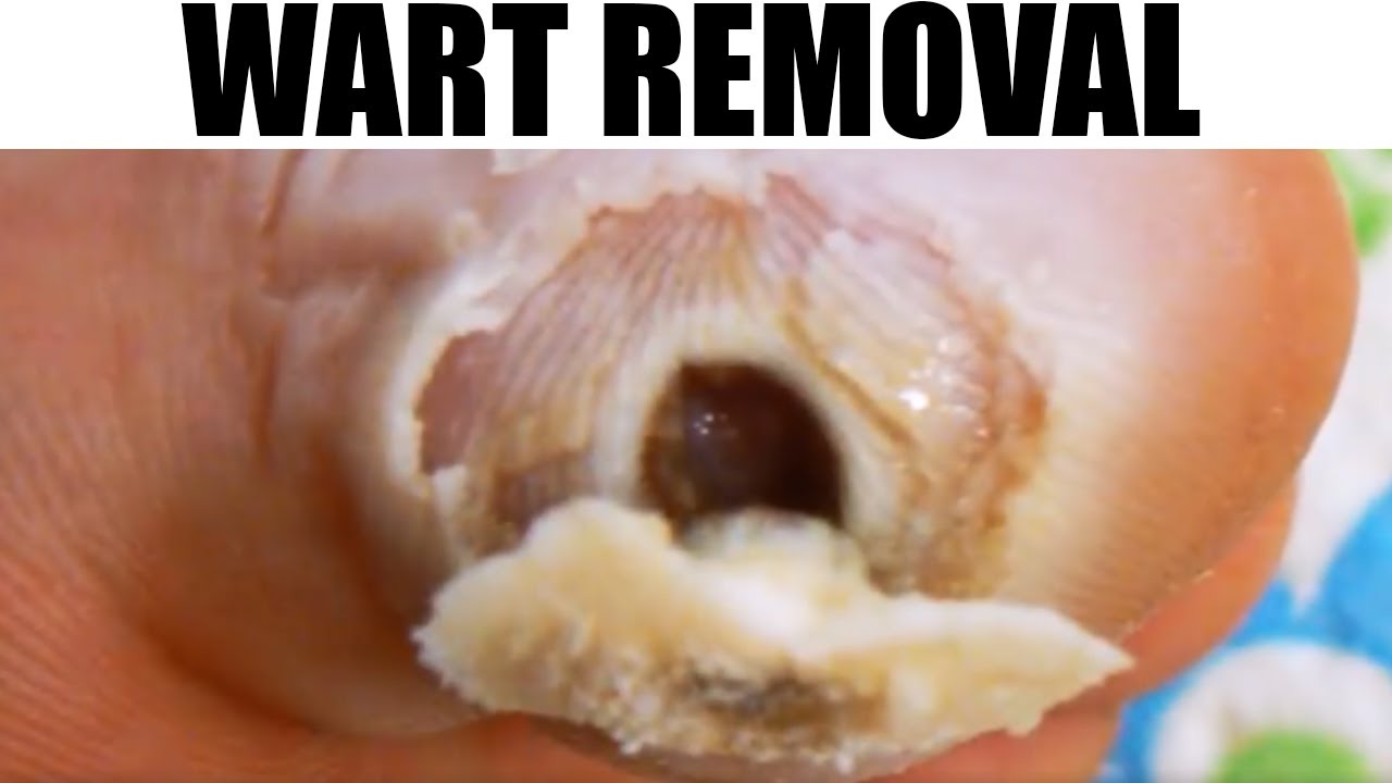 Plantar Wart Removal by Blackhead King - YouTube