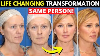 Incredible facelift transformation at 49 years old!