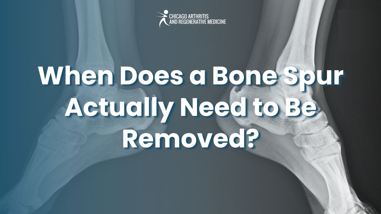 When Does a Bone Spur Actually Need to Be Removed?