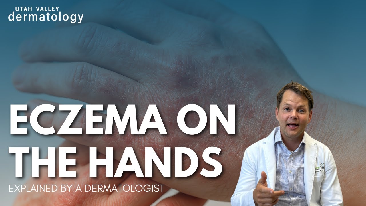 Eczema on the Hands | Utah Valley Dermatology