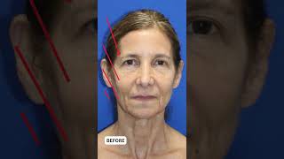 One Year Later Facelift Post-Op Results at 65
