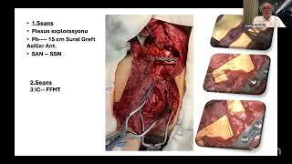 Travmatik Brakial Pleksus Yaralanmalarında Serbest Gracilis Kas Transferi - Prof. Dr. Kadir Bacakoğlu