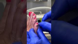 5th Toe Corn Pad ... and debridement | Part 1