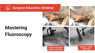 Mastering Fluoroscopy in Lapiplasty®: A Guide to Perfect AP, Lateral and Axial View