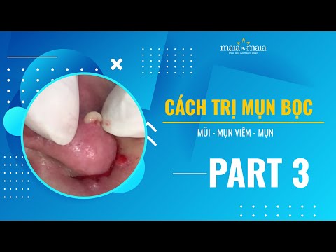 Video Cách trị mụn bọc ở mũi - mụn viêm - mụn nội tiết Part3 - youtube