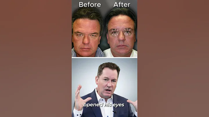 Male Brow & Eye Lift - 47 Years Old