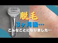 ちくしょう！埋没毛だらけ！脱毛をしようとしている方へ…パナソニック　soieを3ヶ月使ってみたら