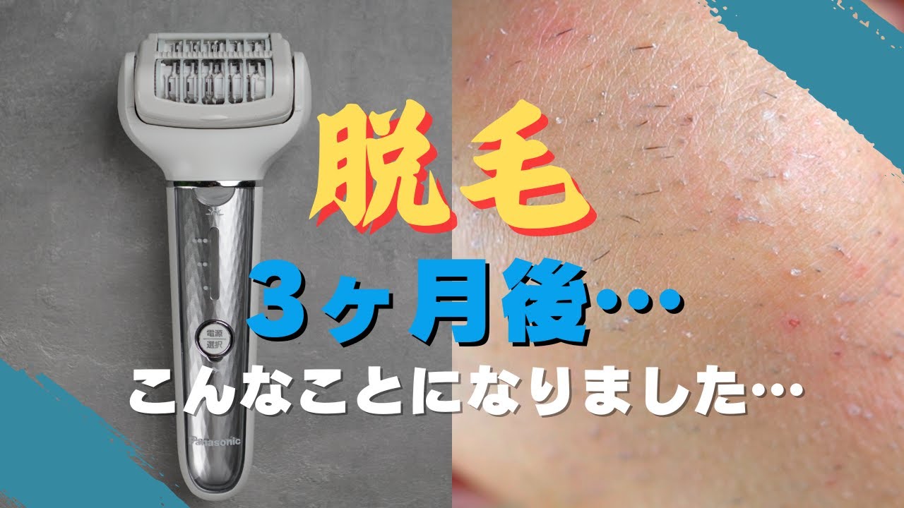 Damn! I'm covered in ingrown hairs! For those considering hair