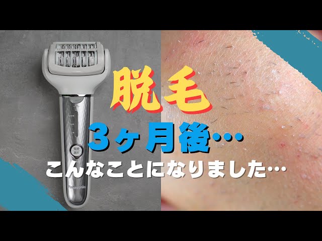 Damn! I'm covered in ingrown hairs! For those considering hair
