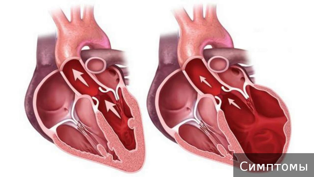 Гипертрофическая кардиомиопатия. Как лечить гипертрофическую кардиомиопатию.