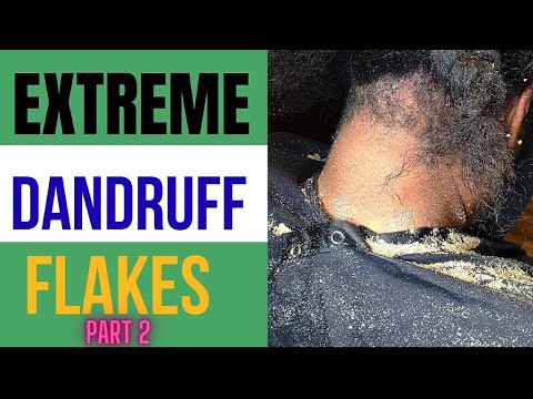Oddly Satisfying Extreme Dandruff Removal Flakes After Braids | Picking Dandruff  Up Close PT 2 - video from xoNecole