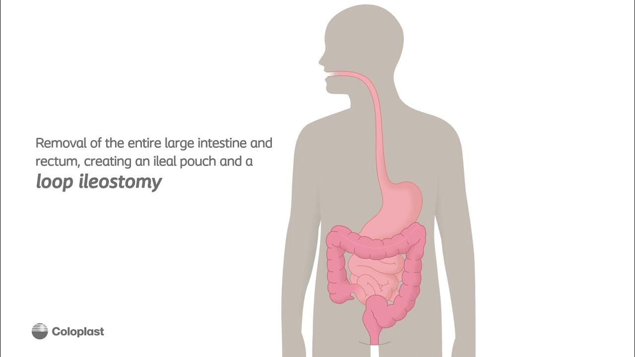 Anatomy of Loop Ileostomy and Pouch Construction YouTube