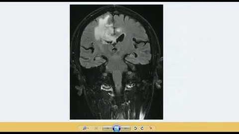 Brain Tumor Segmentation best technique with 3D Visualization | image processing