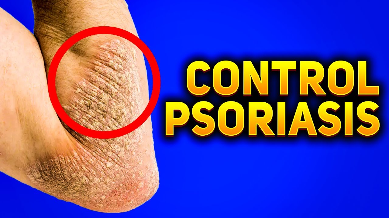 These 5 Effective Psoriasis Treatments Will Stop Your Psoriasis YouTube