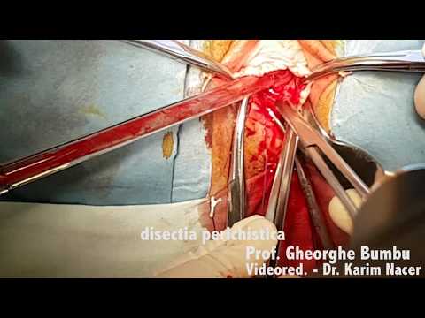 Video: Paraurethral Cyst - Symptoms, Removal And Surgery